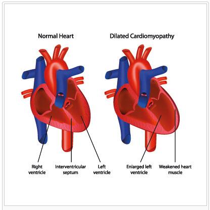 Arrhythmogenic right ventricular cardiomyopathy